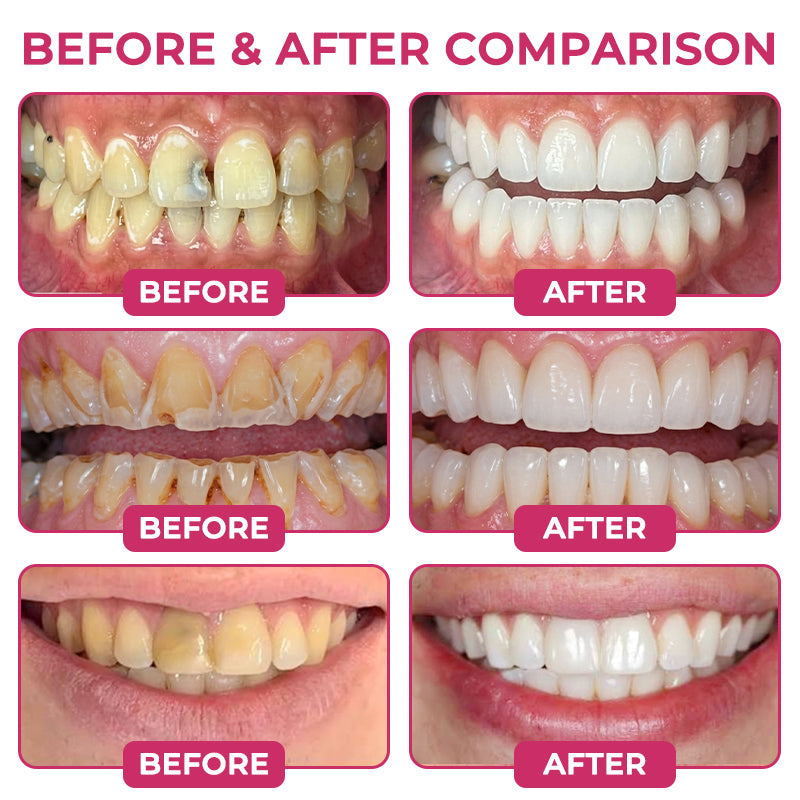 AQA®  Cavity-Repair Natural Enamel Filling Gel
