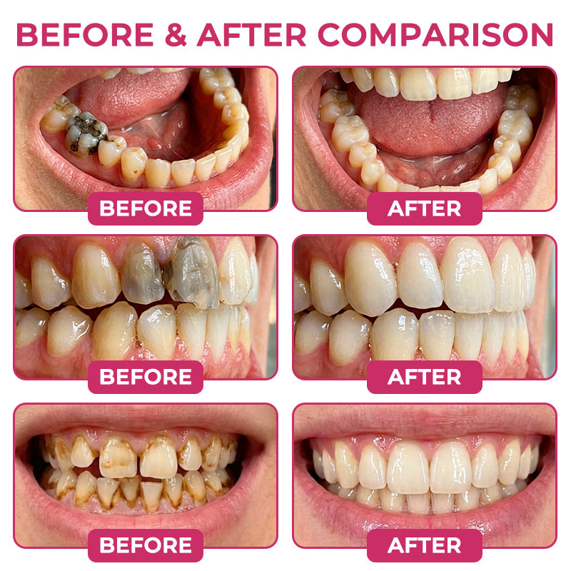 AQA®  Cavity-Repair Natural Enamel Filling Gel